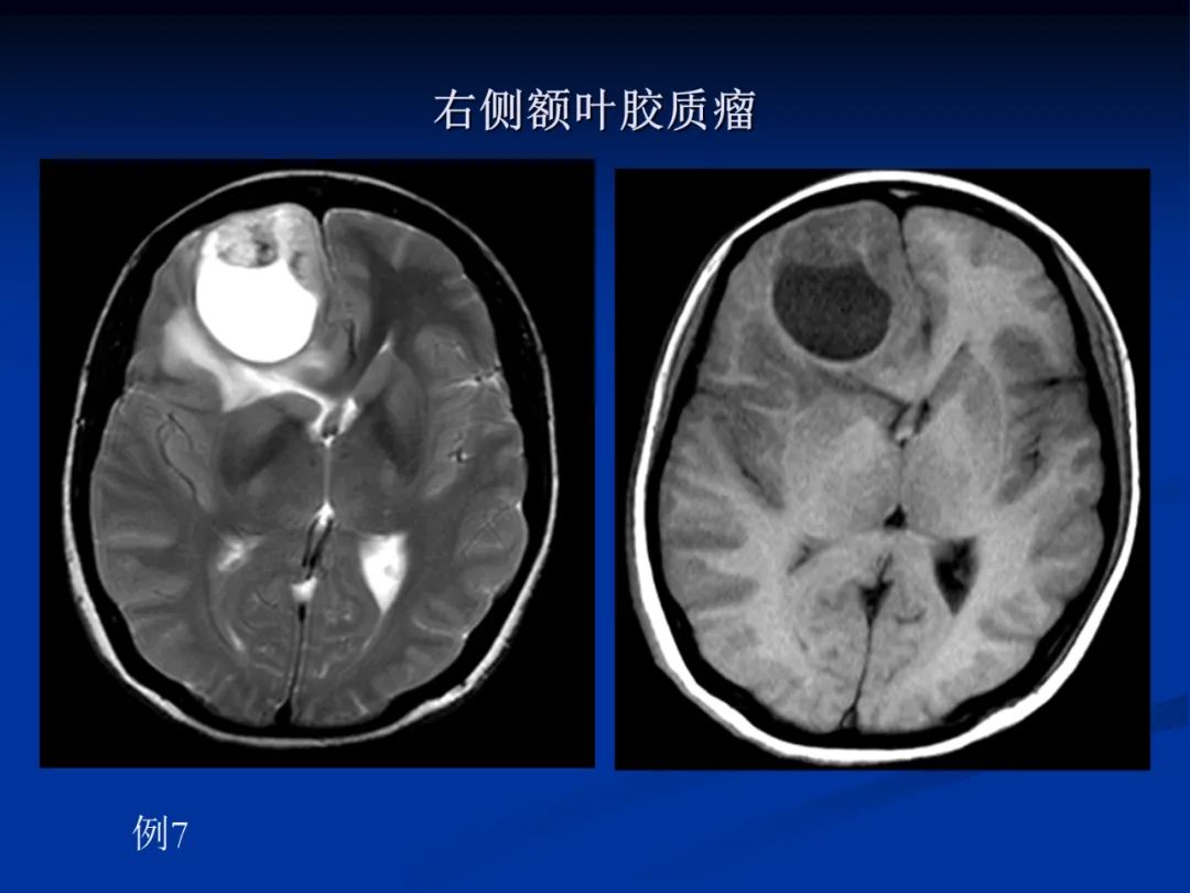 影像PPT - 【PPT】脑肿瘤影像学诊断-33