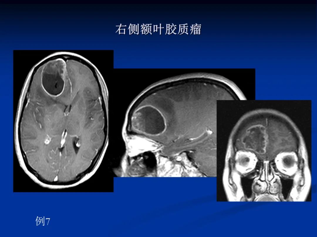 影像PPT - 【PPT】脑肿瘤影像学诊断-34