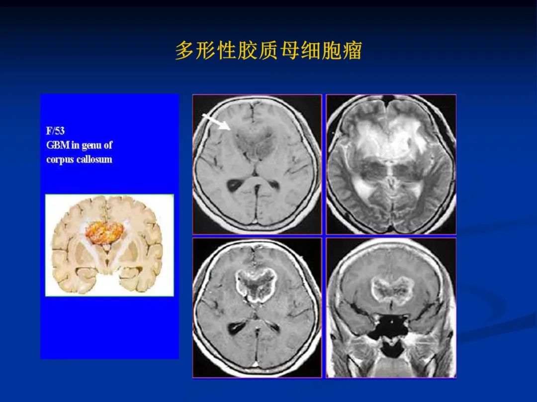 影像PPT - 【PPT】脑肿瘤影像学诊断-35
