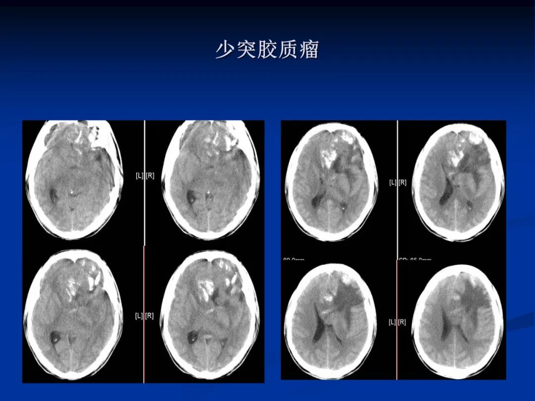 影像PPT - 【PPT】脑肿瘤影像学诊断-37