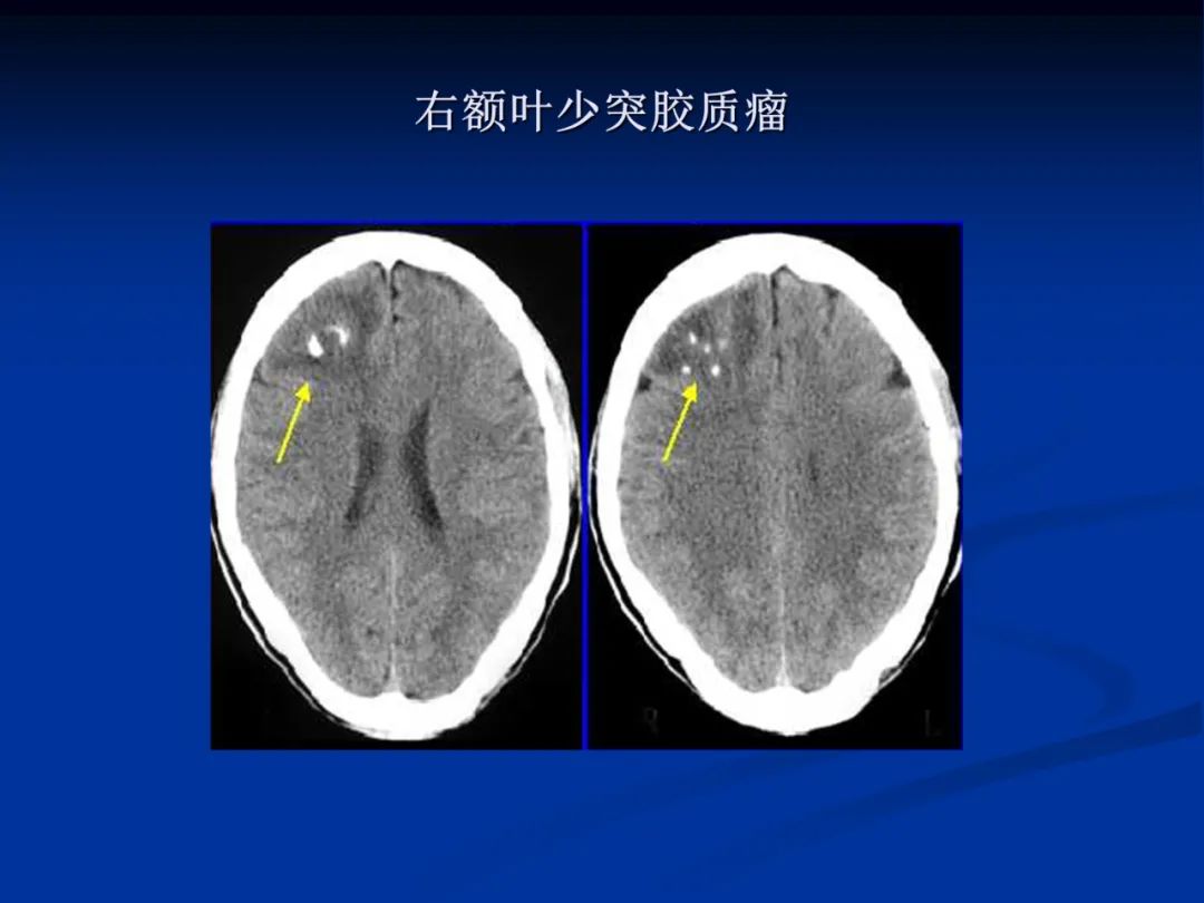 影像PPT - 【PPT】脑肿瘤影像学诊断-38