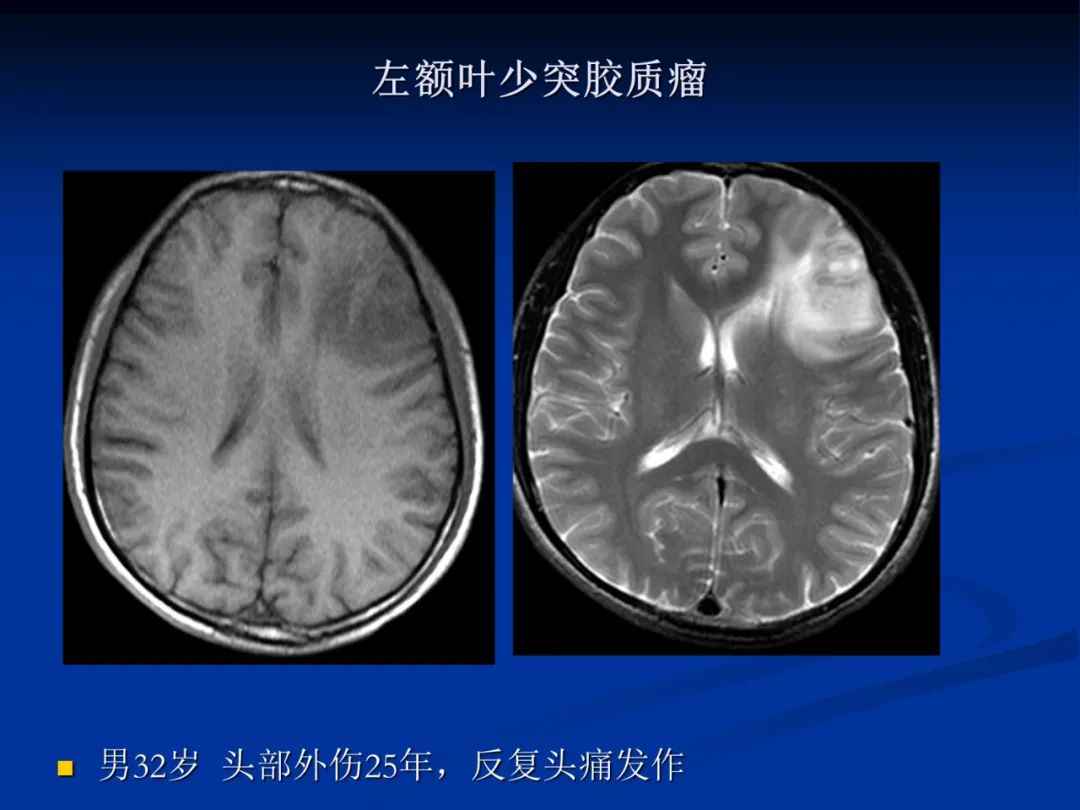 影像PPT - 【PPT】脑肿瘤影像学诊断-39