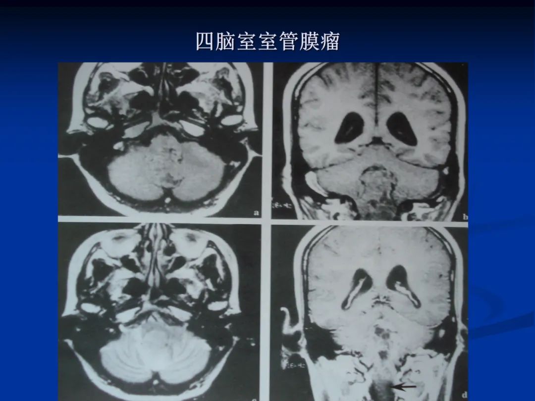 影像PPT - 【PPT】脑肿瘤影像学诊断-43