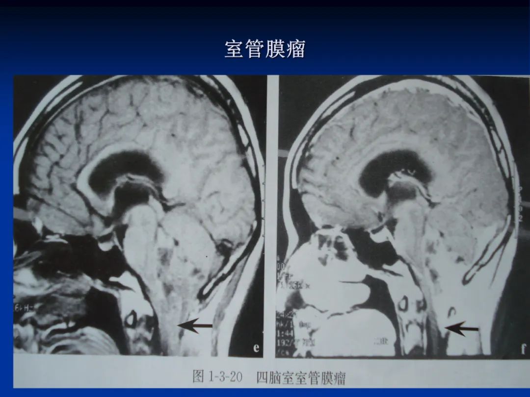影像PPT - 【PPT】脑肿瘤影像学诊断-44