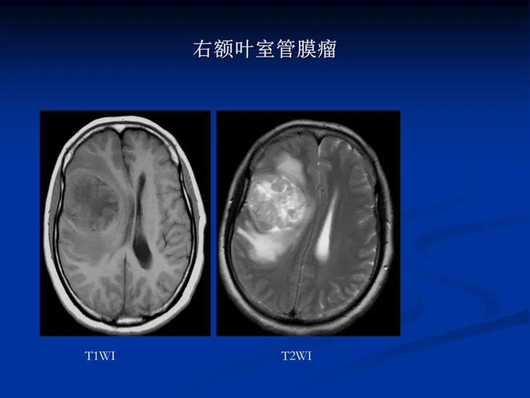 影像PPT - 【PPT】脑肿瘤影像学诊断-45