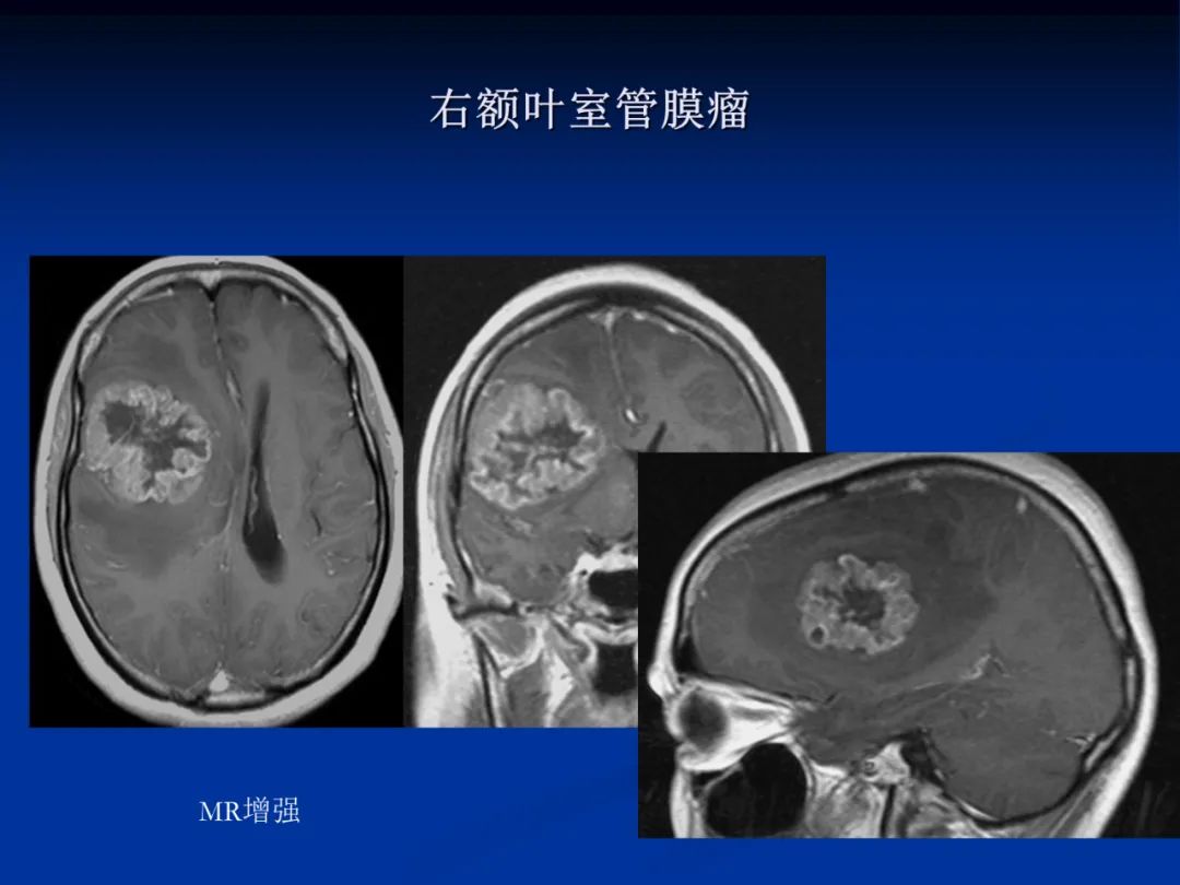 影像PPT - 【PPT】脑肿瘤影像学诊断-46