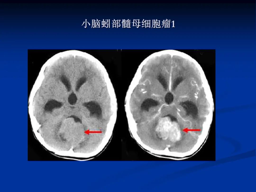 影像PPT - 【PPT】脑肿瘤影像学诊断-48