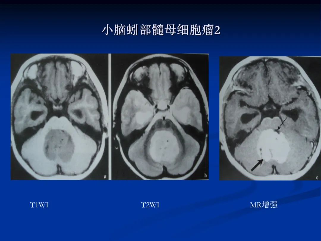 影像PPT - 【PPT】脑肿瘤影像学诊断-49