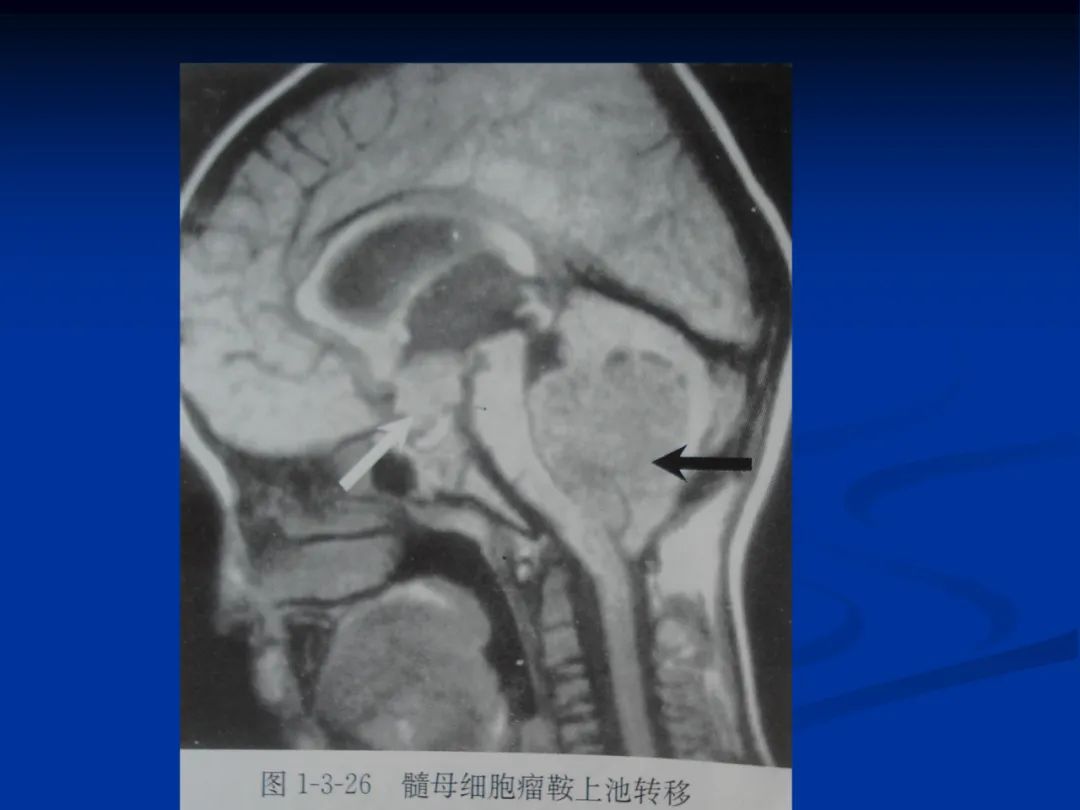 影像PPT - 【PPT】脑肿瘤影像学诊断-50