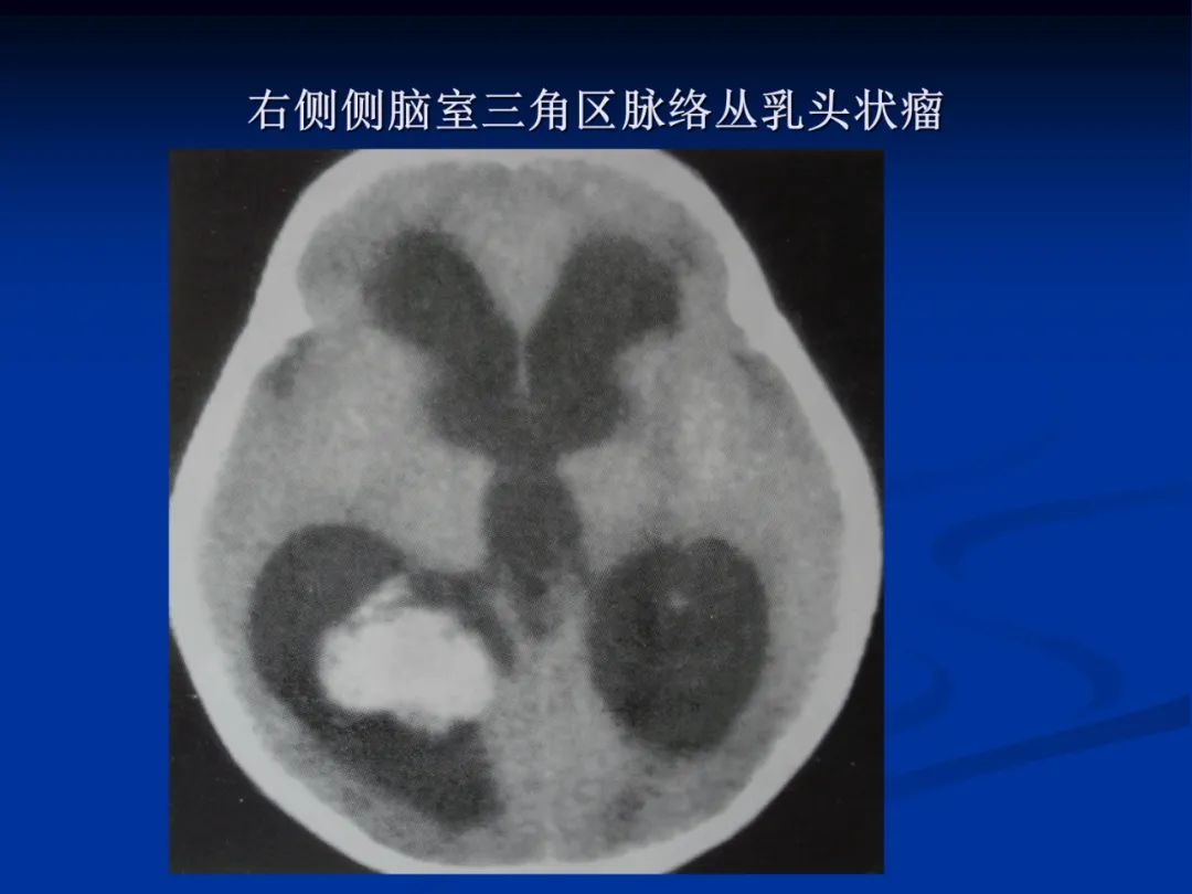 影像PPT - 【PPT】脑肿瘤影像学诊断-52