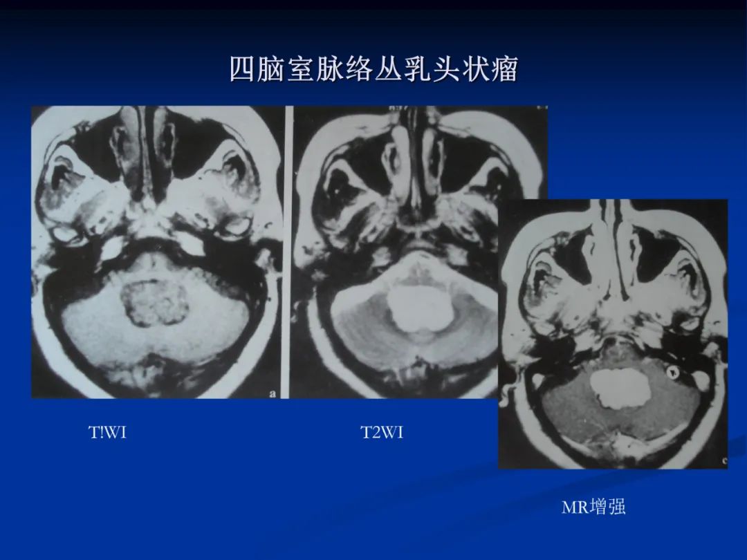 影像PPT - 【PPT】脑肿瘤影像学诊断-53
