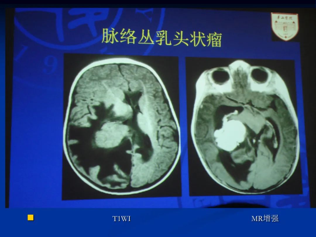 影像PPT - 【PPT】脑肿瘤影像学诊断-54