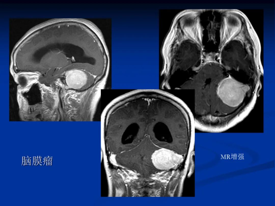 影像PPT - 【PPT】脑肿瘤影像学诊断-59