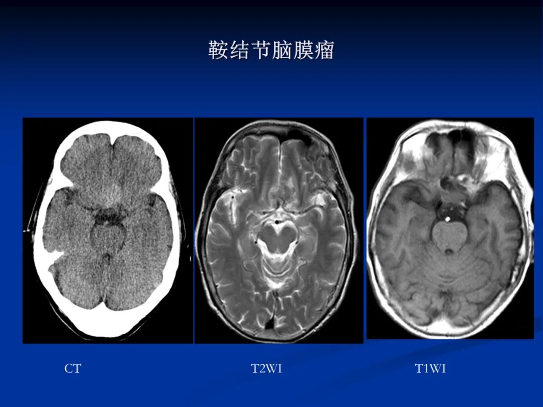 影像PPT - 【PPT】脑肿瘤影像学诊断-63
