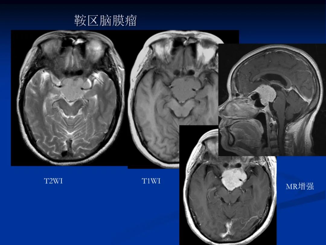 影像PPT - 【PPT】脑肿瘤影像学诊断-60