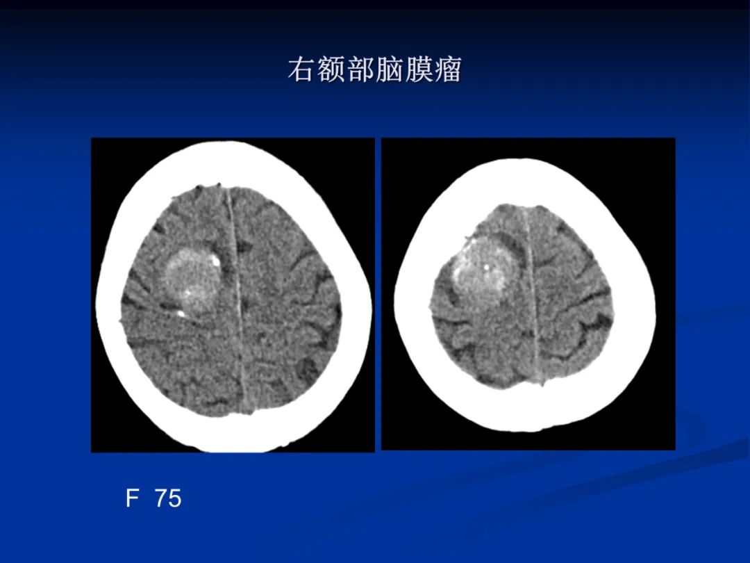 影像PPT - 【PPT】脑肿瘤影像学诊断-61