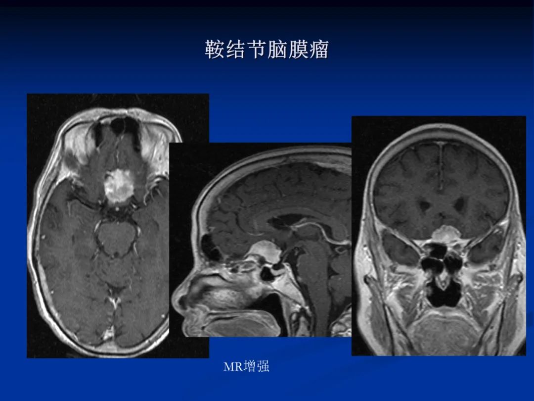 影像PPT - 【PPT】脑肿瘤影像学诊断-65