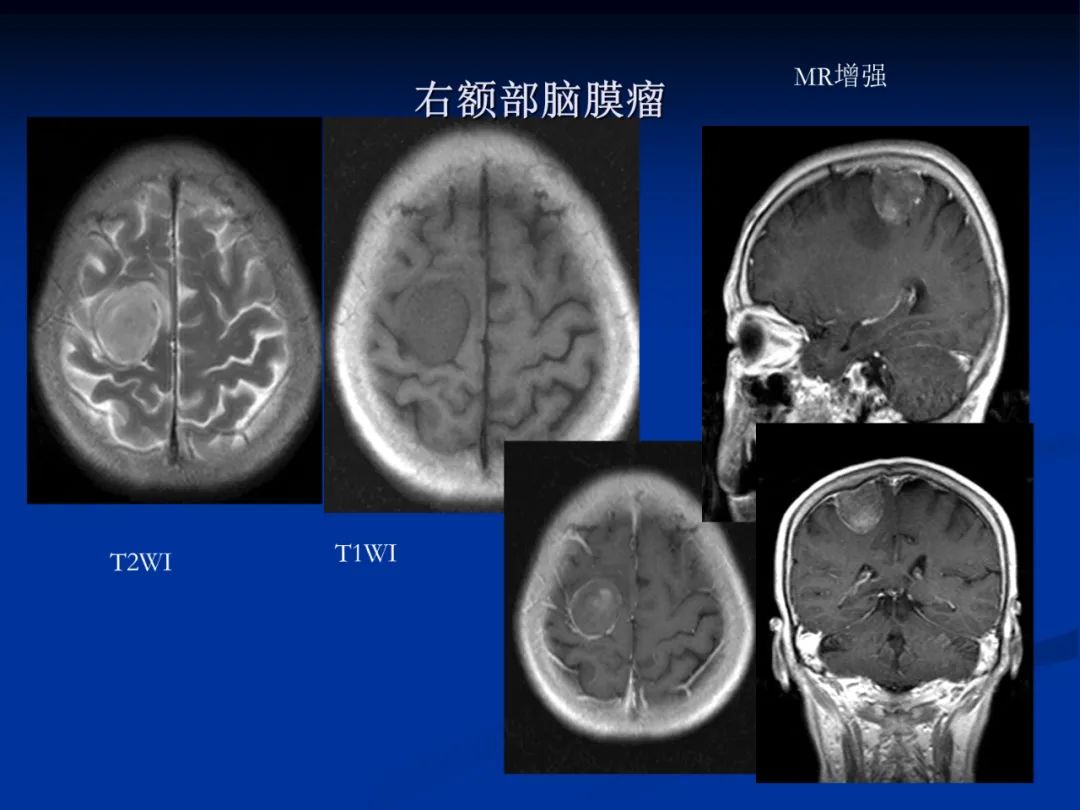 影像PPT - 【PPT】脑肿瘤影像学诊断-62