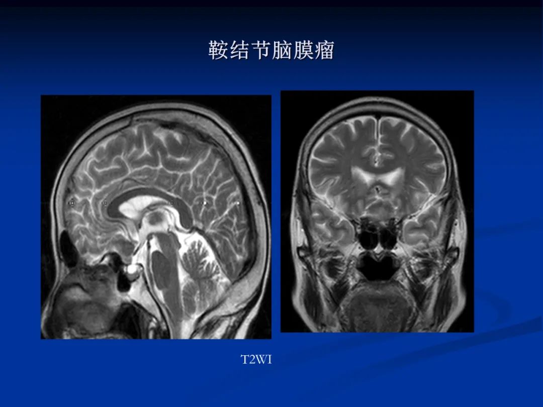 影像PPT - 【PPT】脑肿瘤影像学诊断-64