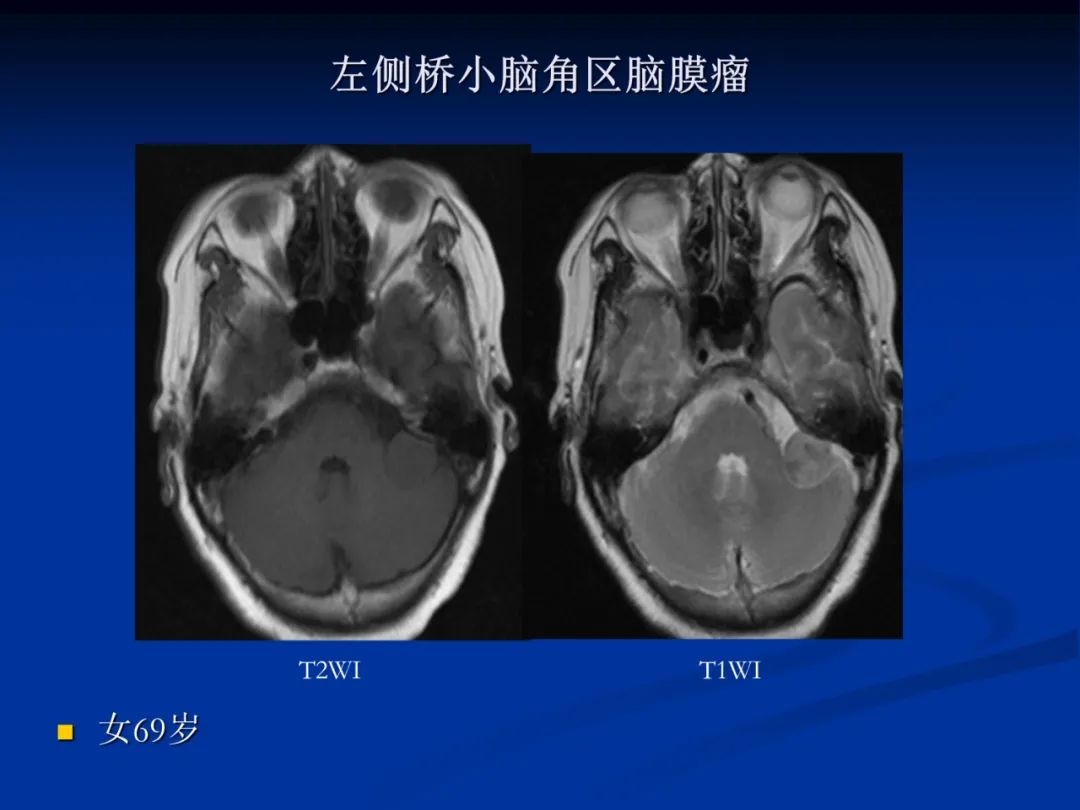 影像PPT - 【PPT】脑肿瘤影像学诊断-73