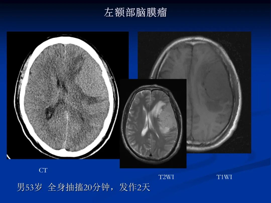 影像PPT - 【PPT】脑肿瘤影像学诊断-69