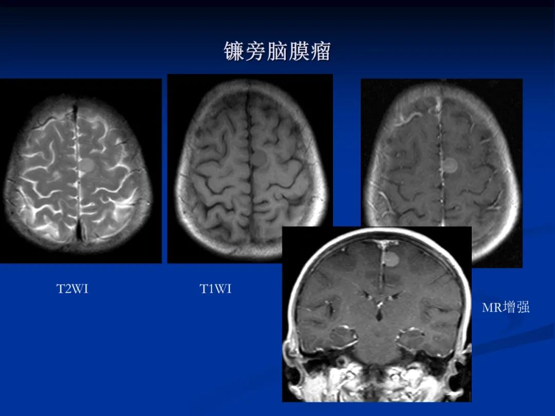 影像PPT - 【PPT】脑肿瘤影像学诊断-68