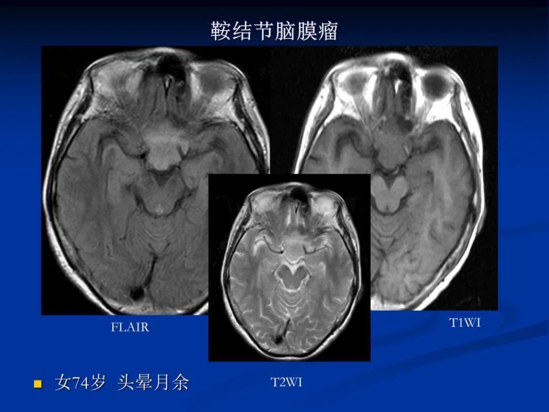 影像PPT - 【PPT】脑肿瘤影像学诊断-66