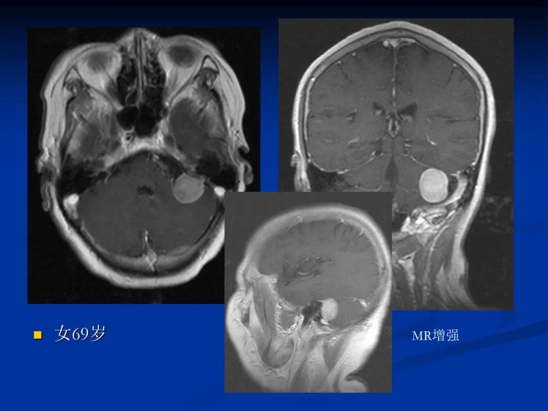 影像PPT - 【PPT】脑肿瘤影像学诊断-74