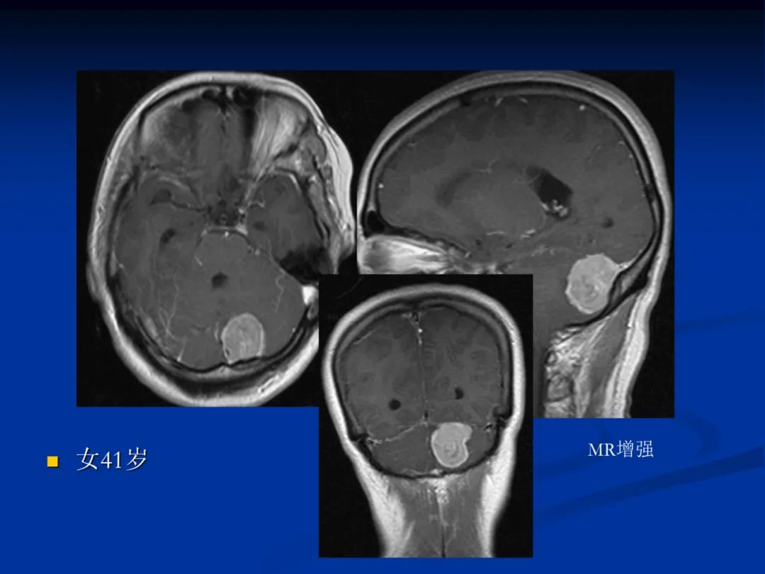 影像PPT - 【PPT】脑肿瘤影像学诊断-72