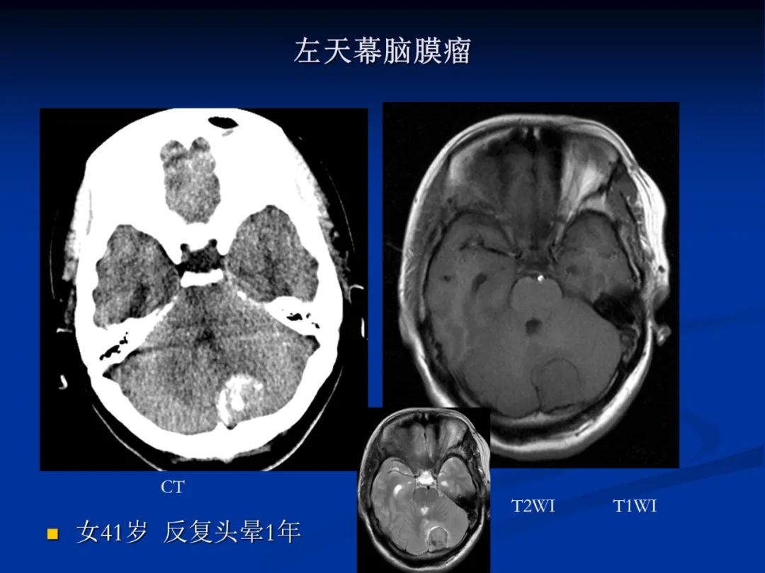 影像PPT - 【PPT】脑肿瘤影像学诊断-71
