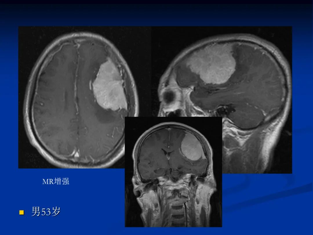 影像PPT - 【PPT】脑肿瘤影像学诊断-70