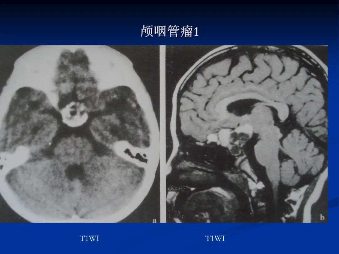 影像PPT - 【PPT】脑肿瘤影像学诊断-77