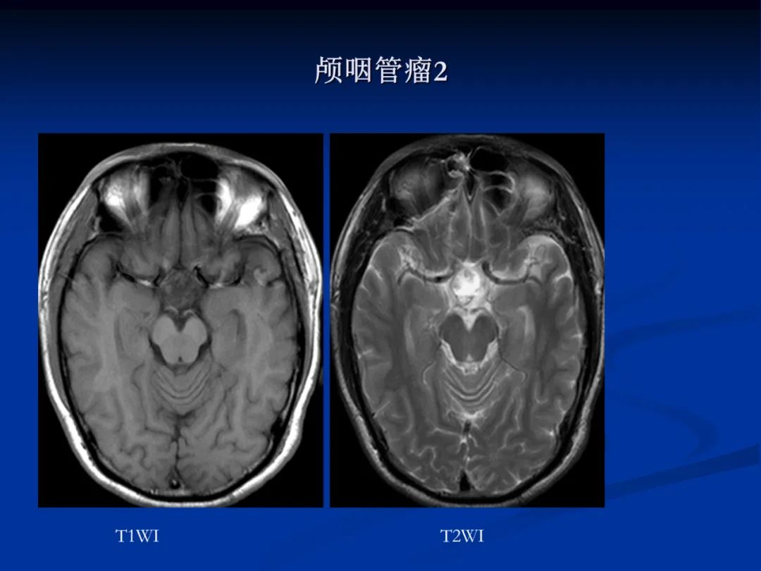 影像PPT - 【PPT】脑肿瘤影像学诊断-79