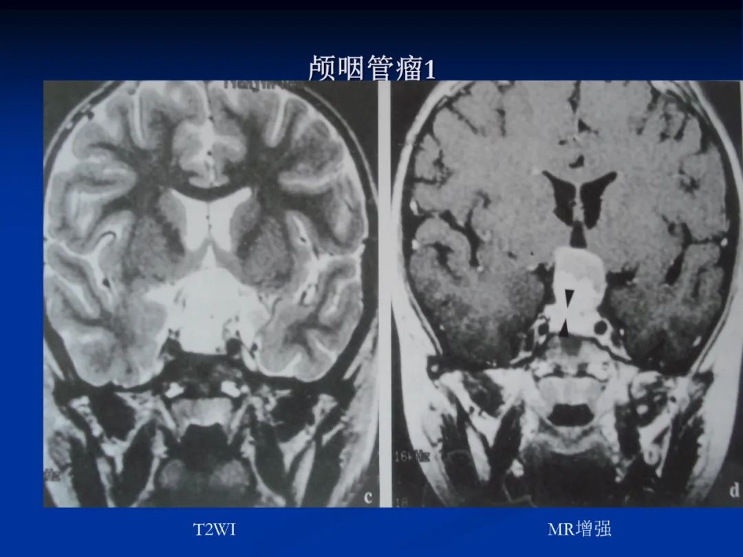 影像PPT - 【PPT】脑肿瘤影像学诊断-78