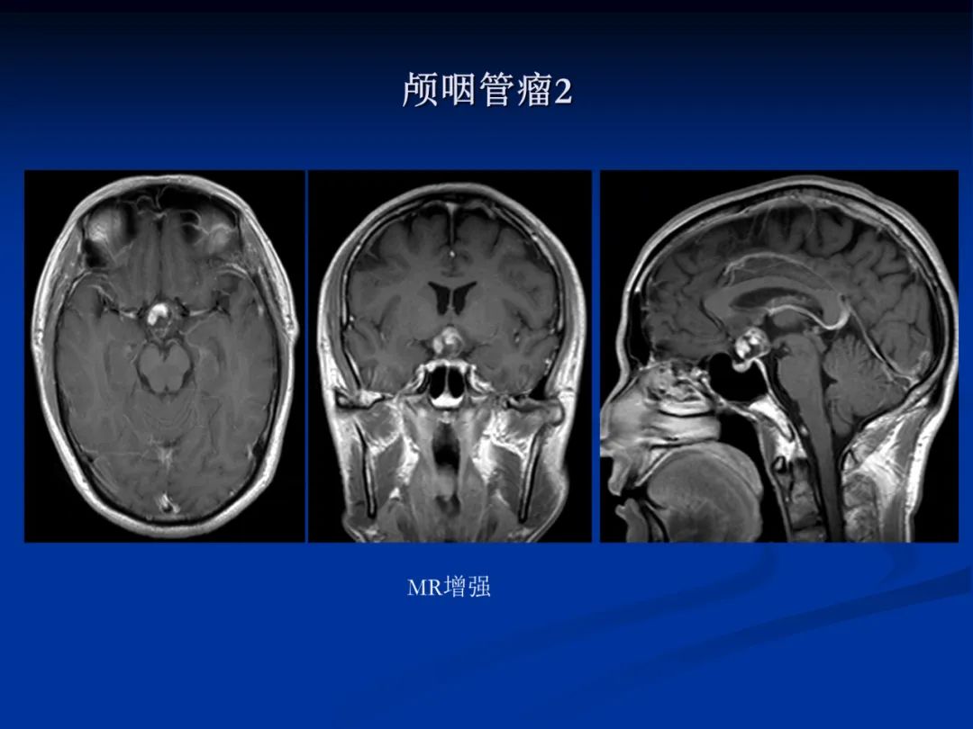影像PPT - 【PPT】脑肿瘤影像学诊断-80