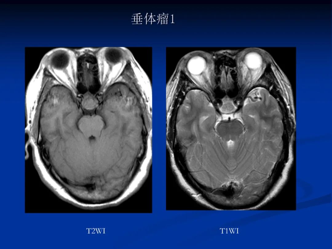 影像PPT - 【PPT】脑肿瘤影像学诊断-86
