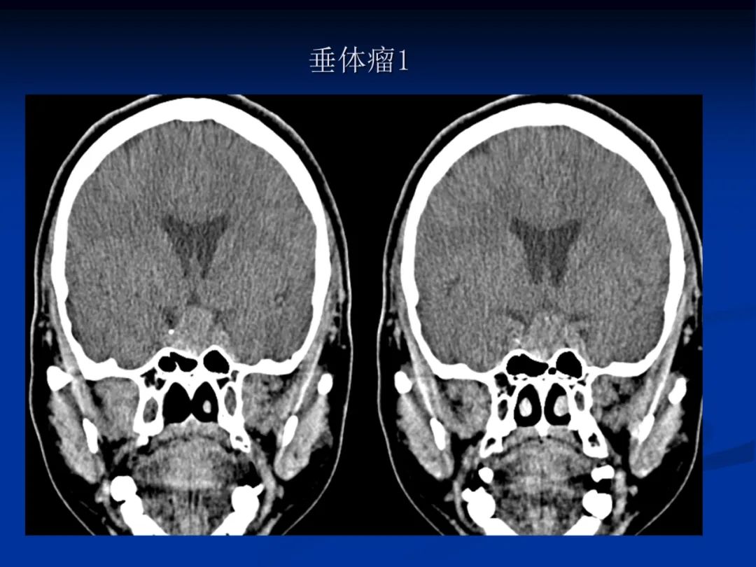 影像PPT - 【PPT】脑肿瘤影像学诊断-85