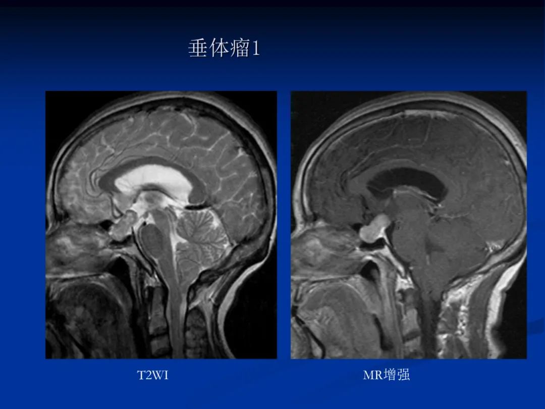 影像PPT - 【PPT】脑肿瘤影像学诊断-87