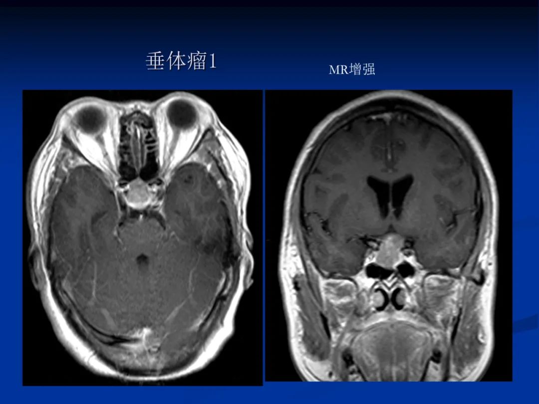影像PPT - 【PPT】脑肿瘤影像学诊断-88