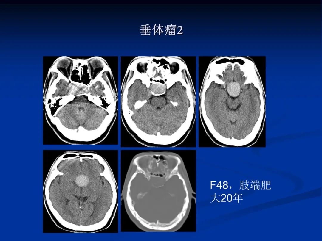影像PPT - 【PPT】脑肿瘤影像学诊断-89