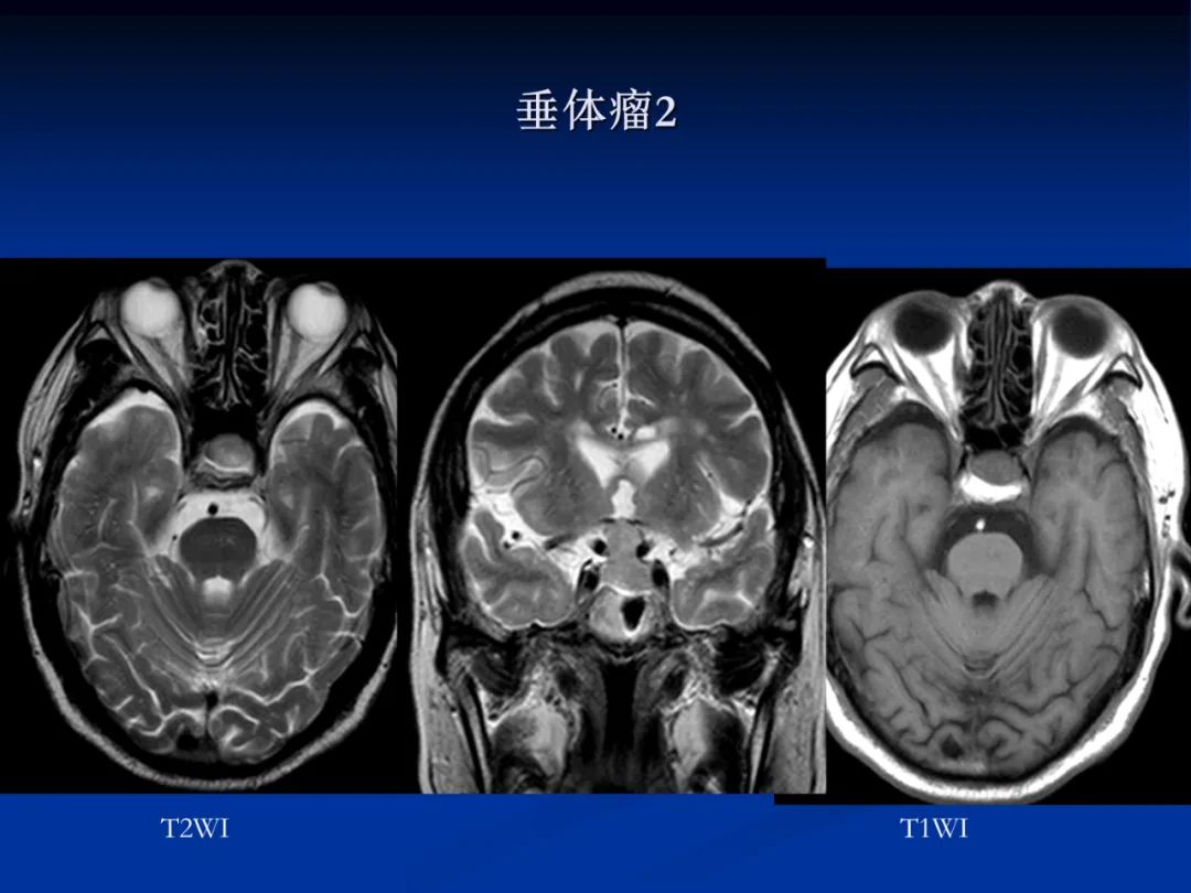 影像PPT - 【PPT】脑肿瘤影像学诊断-90
