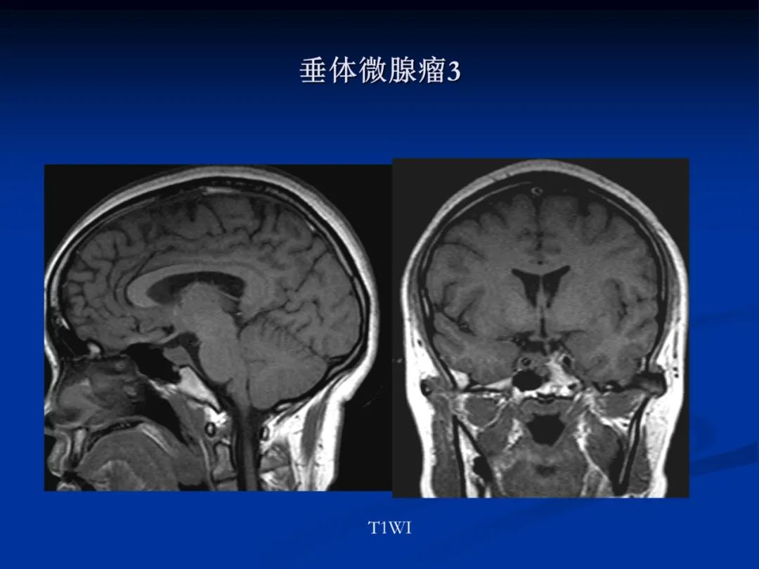 影像PPT - 【PPT】脑肿瘤影像学诊断-91