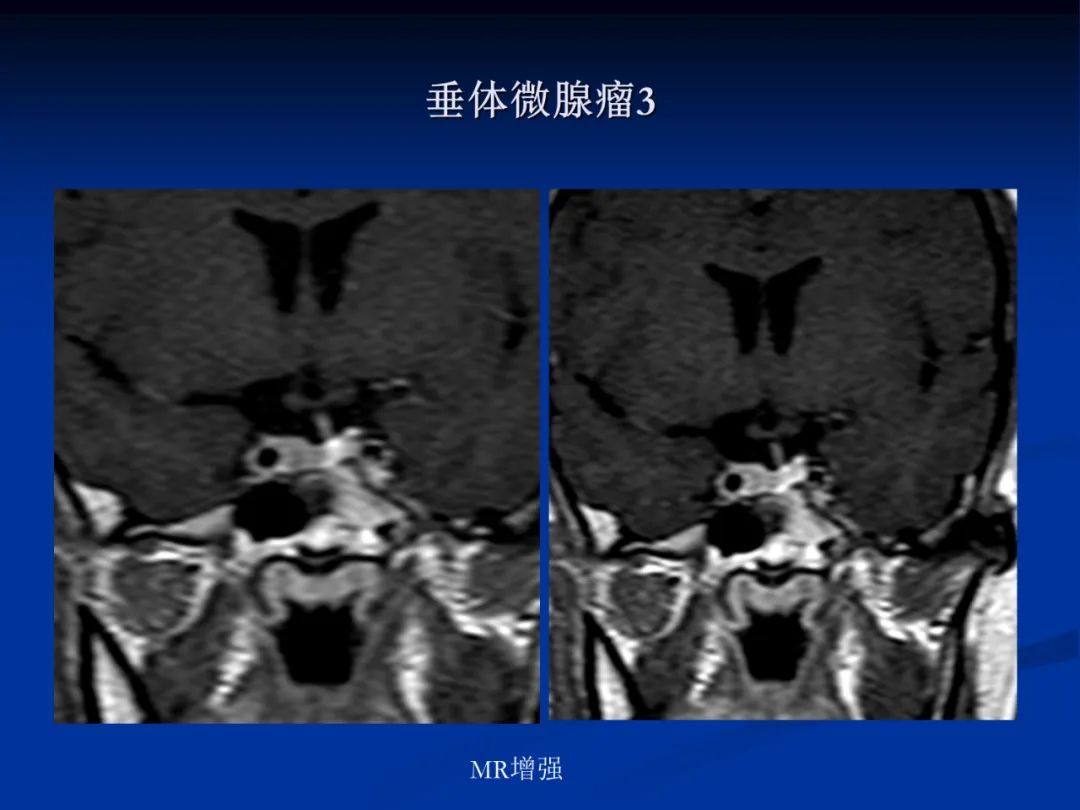 影像PPT - 【PPT】脑肿瘤影像学诊断-92
