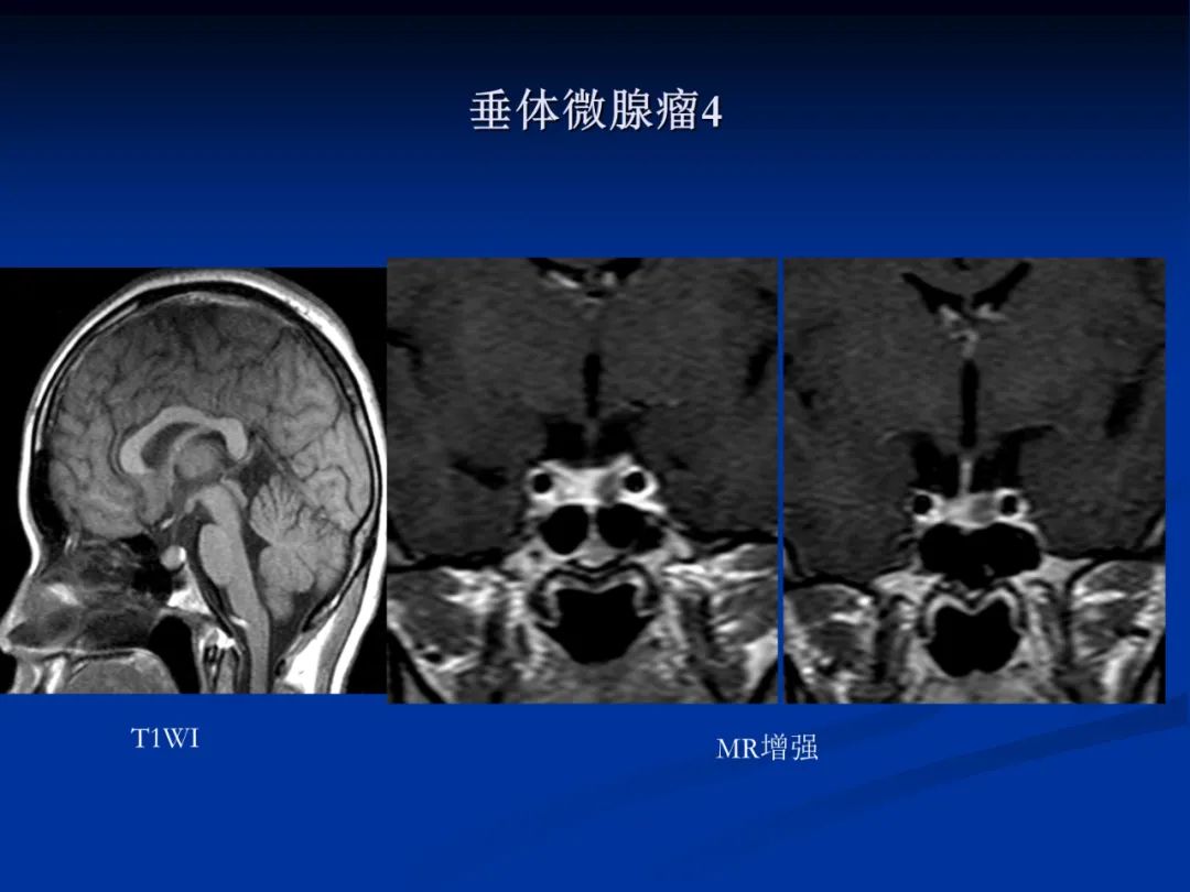 影像PPT - 【PPT】脑肿瘤影像学诊断-93