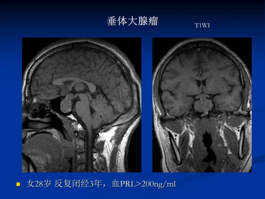 影像PPT - 【PPT】脑肿瘤影像学诊断-94