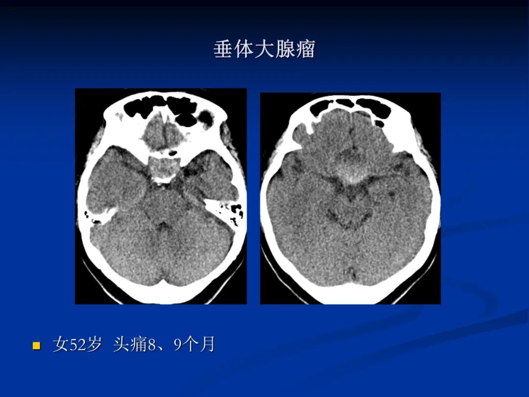 影像PPT - 【PPT】脑肿瘤影像学诊断-97