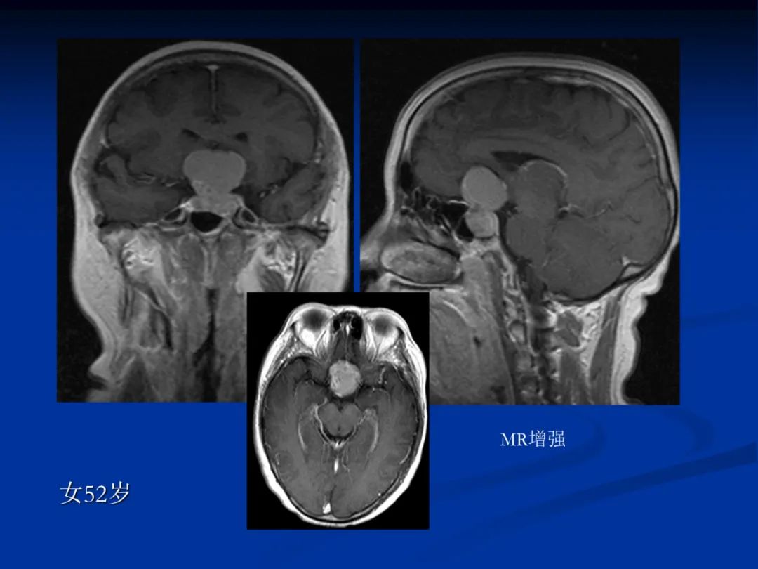影像PPT - 【PPT】脑肿瘤影像学诊断-99