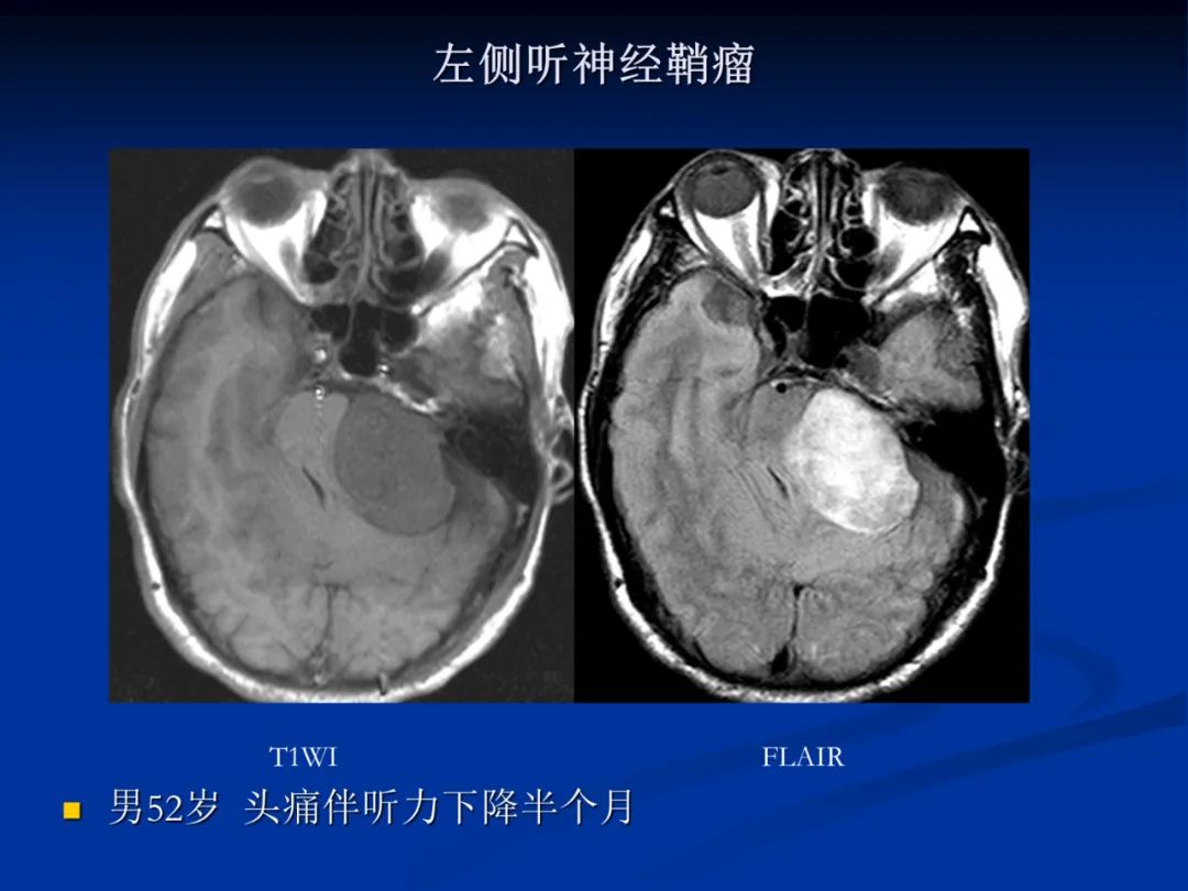 影像PPT - 【PPT】脑肿瘤影像学诊断-101