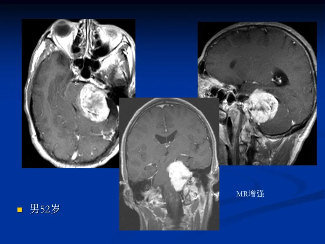 影像PPT - 【PPT】脑肿瘤影像学诊断-102