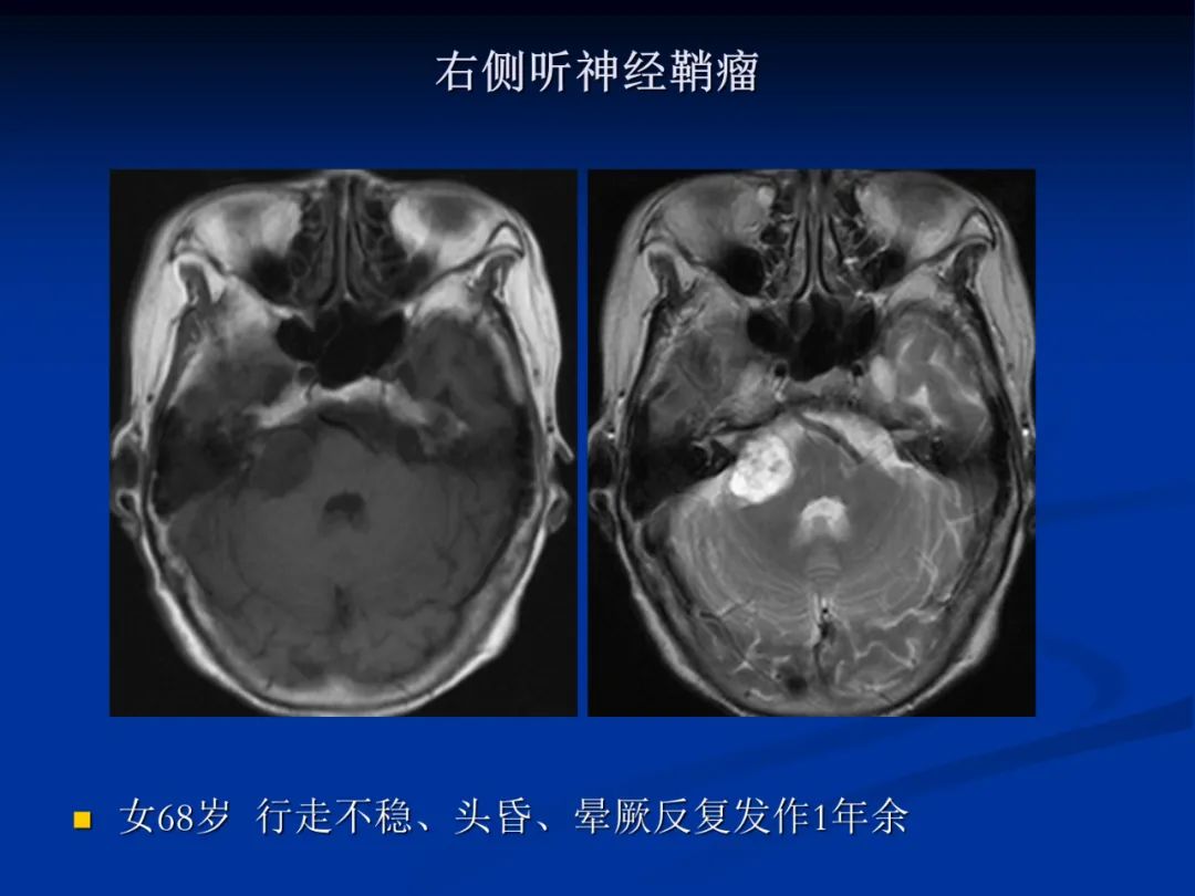 影像PPT - 【PPT】脑肿瘤影像学诊断-103